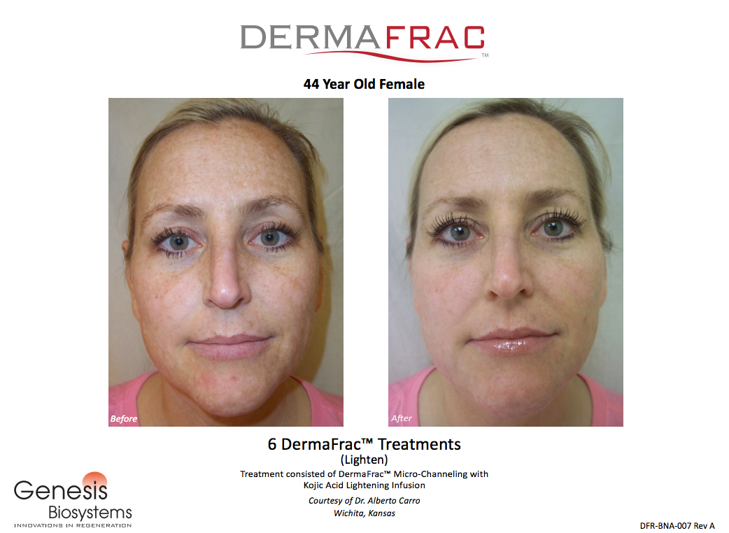 Micro-Needling Treatment in McAllen & Harlingen – Spa La Posada